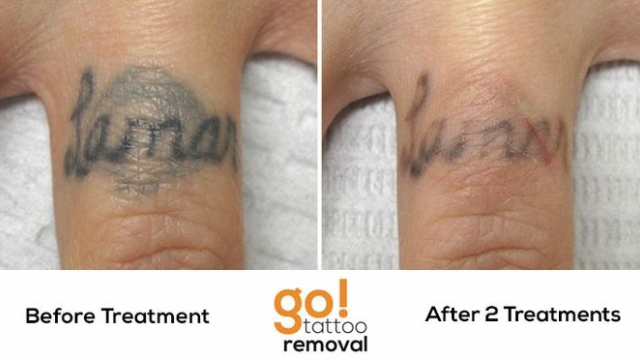 Cost Of Removing A Tattoo