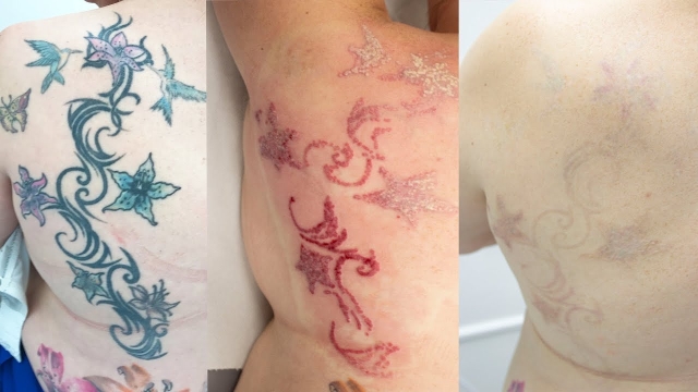 Laser – The New Technology For Tattoo Deletion!