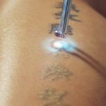 Popular Ways Of Tattoo Removal