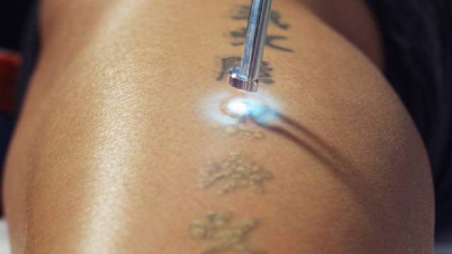 Popular Ways Of Tattoo Removal
