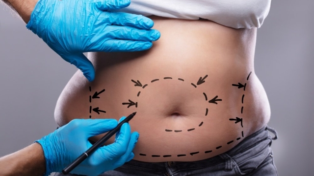 Rock Your Flat Tummy: Unveiling the Magic of Abdominoplasty