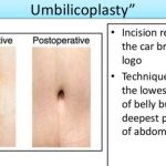 Transforming Your Tummy: Unveiling the Wonders of Abdominoplasty