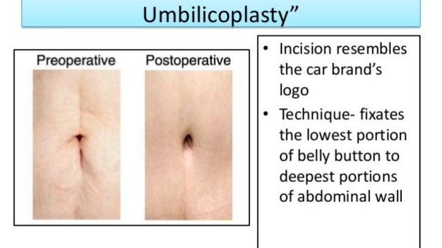 Transforming Your Tummy: Unveiling the Wonders of Abdominoplasty