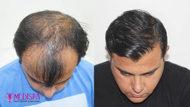 Hair Transplants: Unlocking the Secret to a Fuller Mane