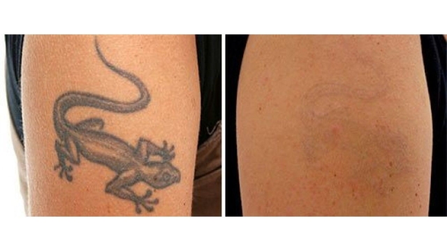 Popular Methods Of Tattoo Removal