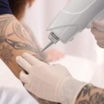 Understanding Tattoo Removal Cost Factors