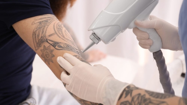 Understanding Tattoo Removal Cost Factors